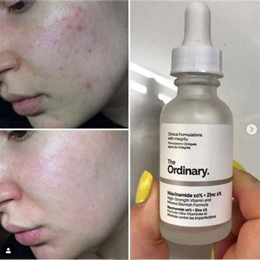 The Ordinary Niacinamide 10% + Zinc 1%, Smoothing Serum for Blemish-Prone Skin